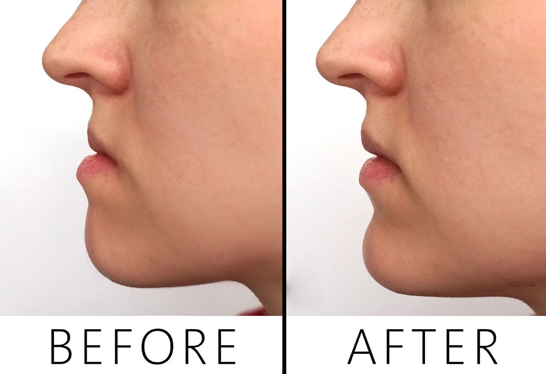 Jaw Orthodontic Transformations