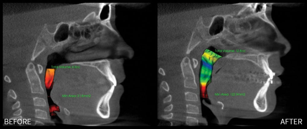 Airway Orthodontics in Milwaukee, WI, Beloit, WI and Roscoe, IL