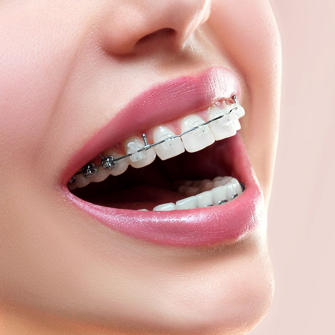 Clear/Ceramic Braces in Milwaukee, WI, Beloit, WI and Roscoe, IL