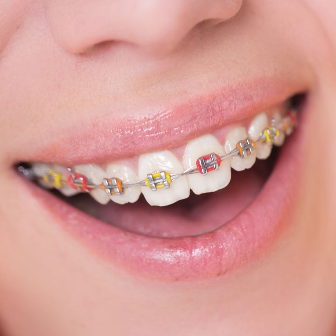 (Un)Traditional Braces in Milwaukee, WI, Beloit, WI and Roscoe, IL