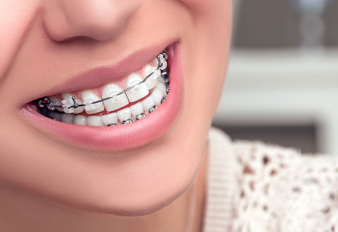 Clear/Ceramic Braces in Milwaukee, WI, Beloit, WI and Roscoe, IL