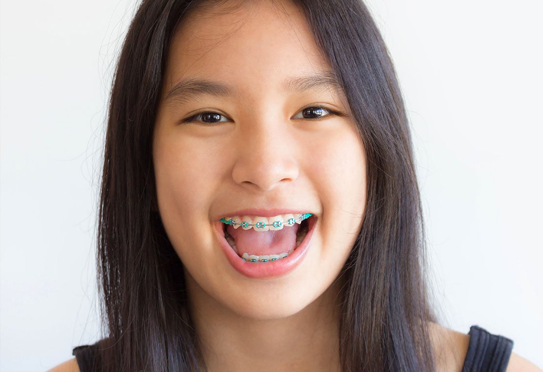 Un)Traditional Braces, Colored Metal Braces in Milwaukee WI, Beloit WI,  and Roscoe IL