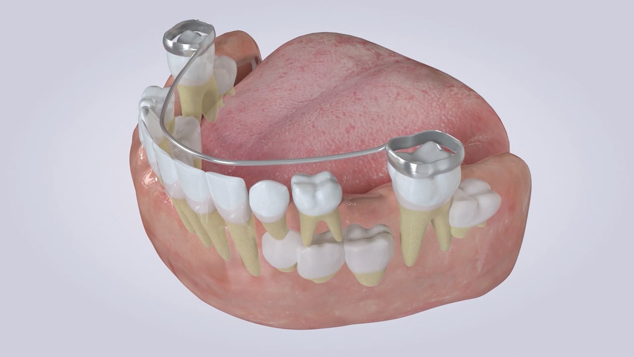 Poster image for the Lower Lingual Holding Arch patient-education video