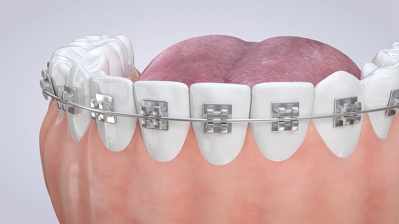 Poster image for the Orthodontics patient-education video