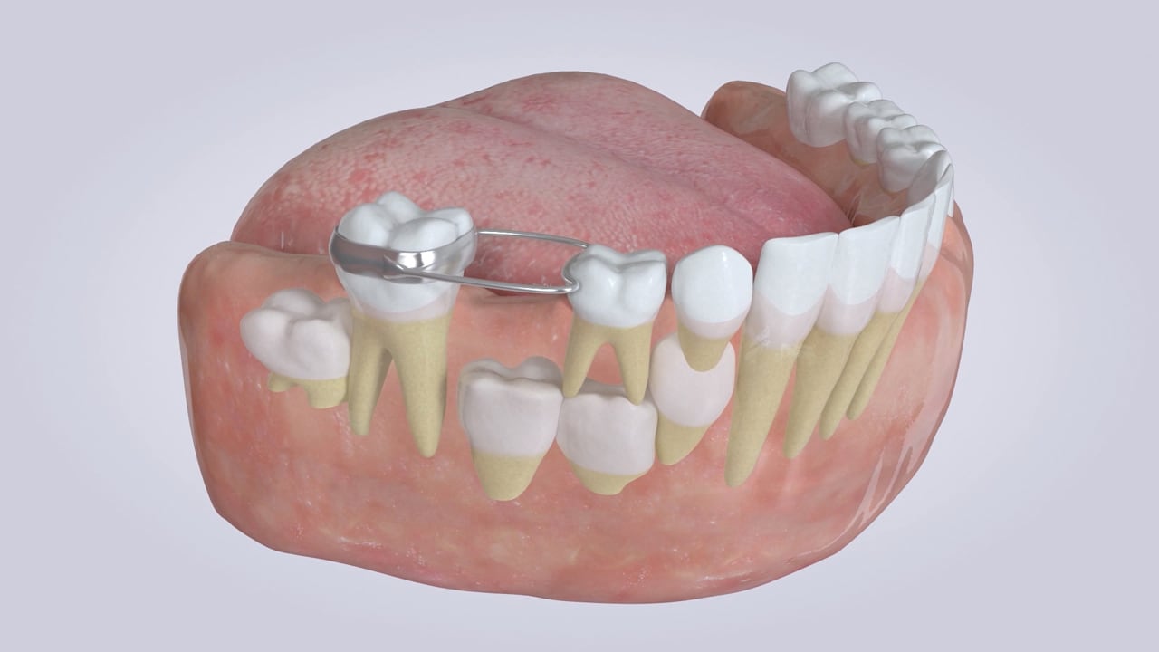 Poster image for the Space Maintainers patient-education video